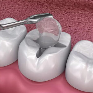 Quality Dental Fillings by Tulip Dental Care near Spring, TX!
