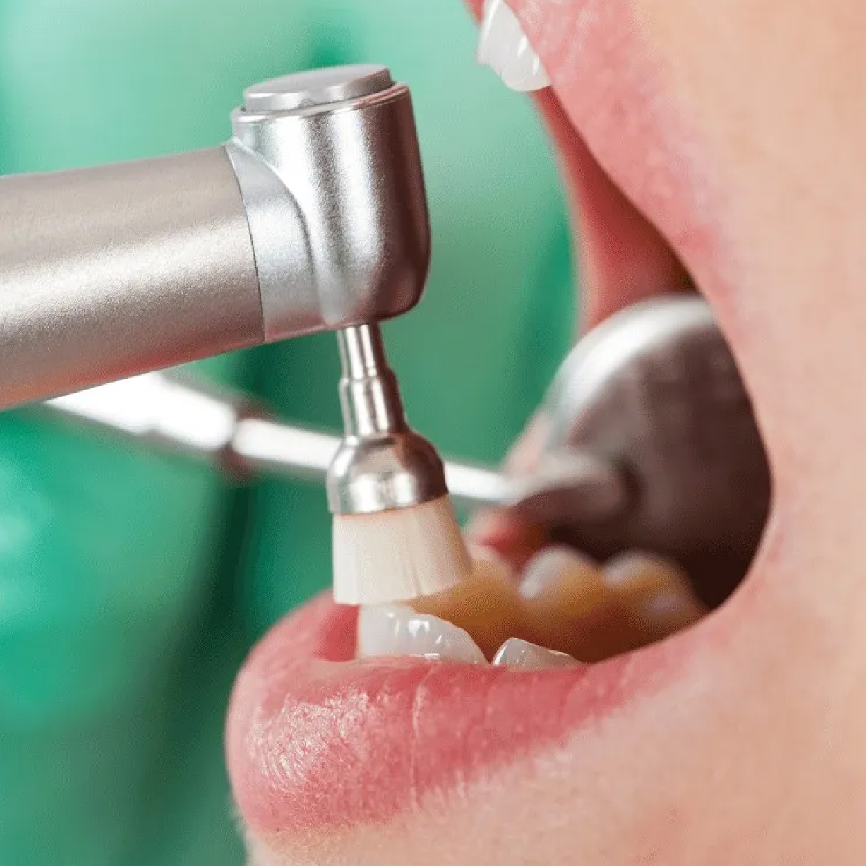 Dental Cleaning and Exam in Spring & Woodlands TX