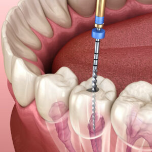 Expert Root Canal Treatment at Tulip Dental Care!