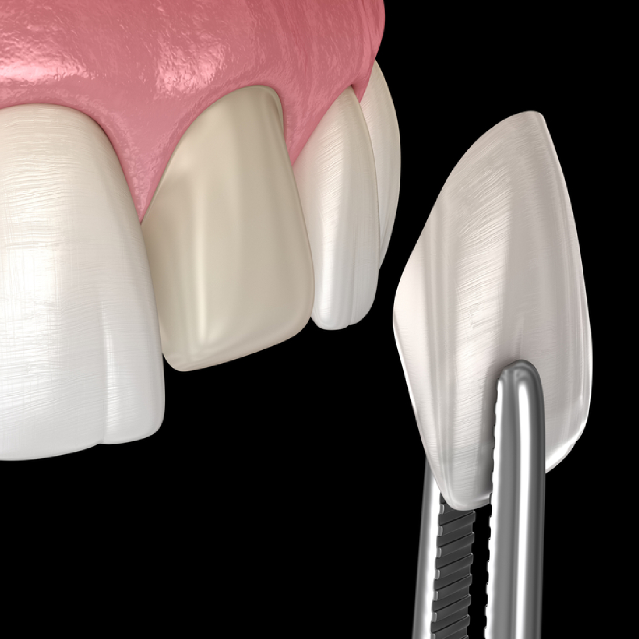 Dental Veneers in Spring & Woodlands TX Tulip Dental Care