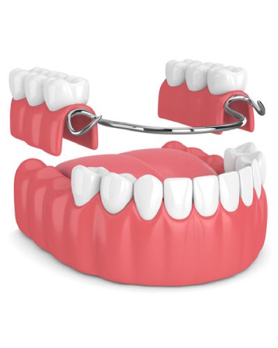 Removal dentures images-34 (2)